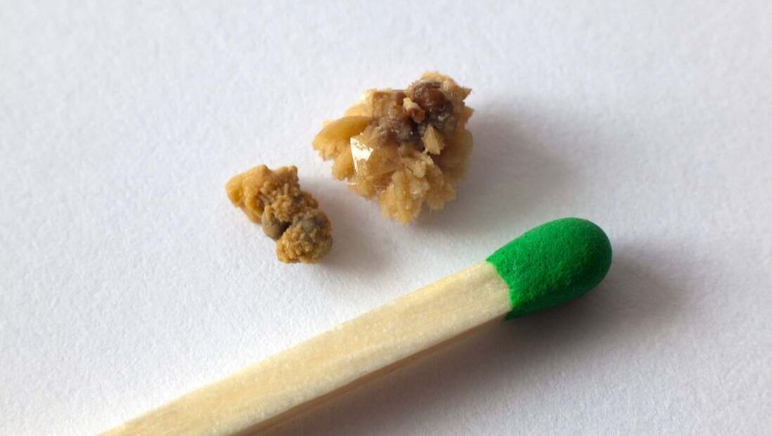 Kidney stones set next to matchstick for scale